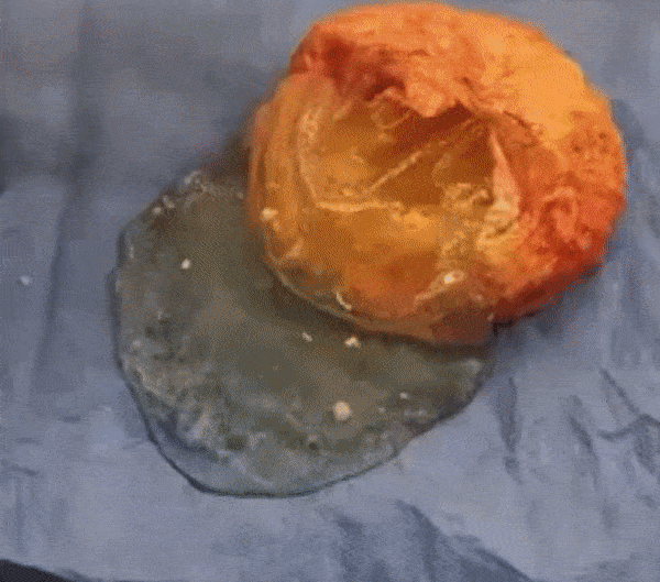 36년된 보형물 / 틱톡